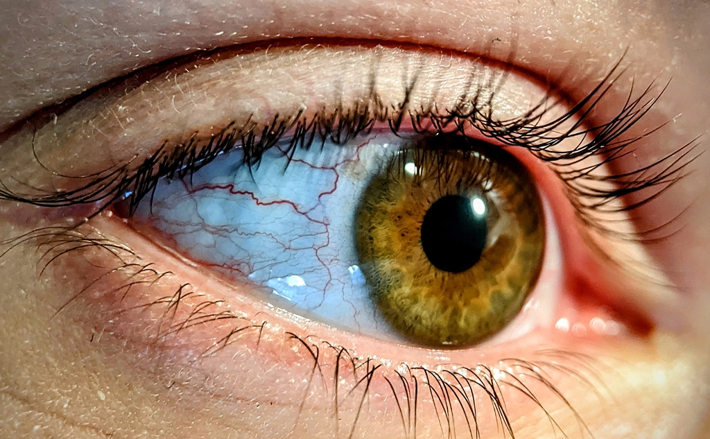 Глаукома: причини виникнення, симптоми, діагностика та лікування